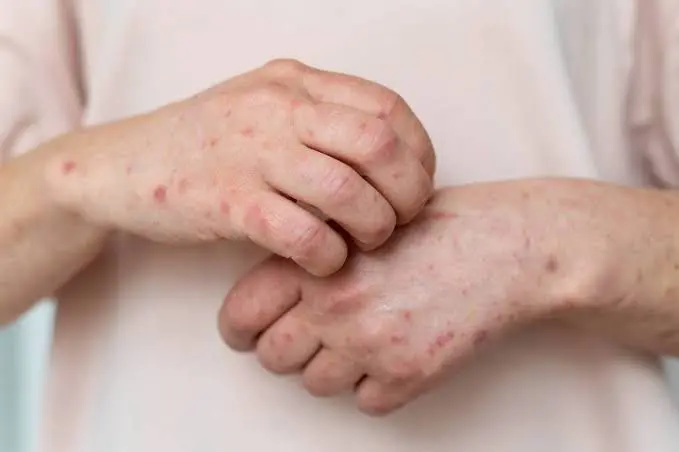 Alerta sanitaria por sarampión: México encabeza aumento de contagios antes del Mundial 2026