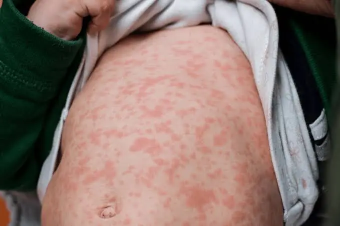 Aumentan casos de sarampión en el país; Michoacán ocupa el cuarto lugar nacional