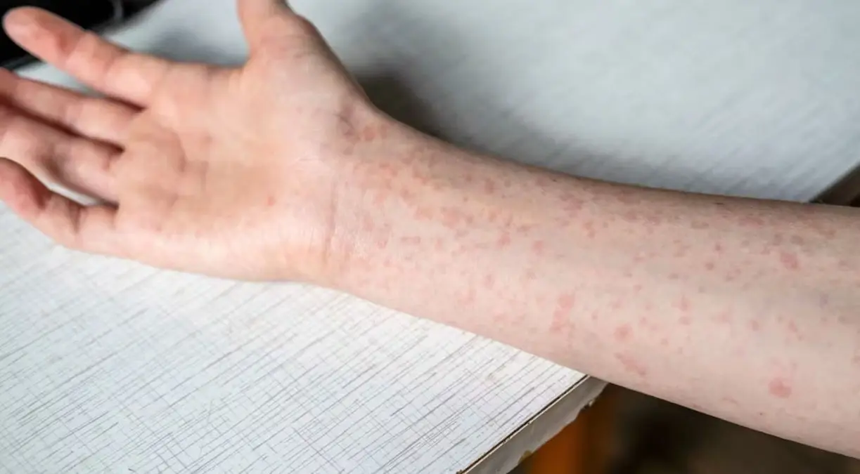 Confirman 3 casos importados de sarampión en Morelos