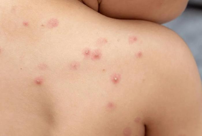 Confirman caso de Mpox en Chiapas: paciente en aislamiento