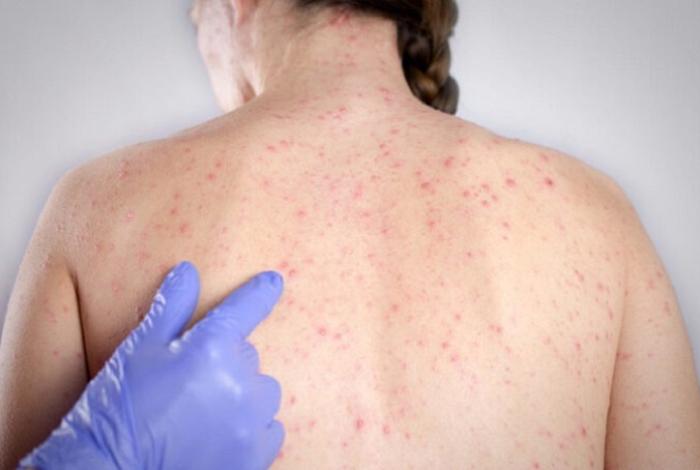 El Mundial podría provocar nueva oleada de casos de sarampión en México, alertan expertos