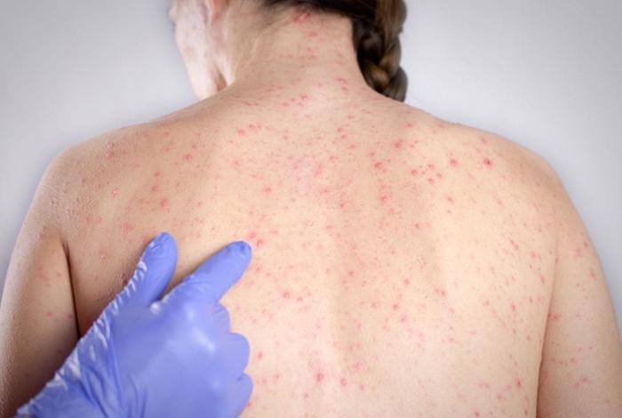 El virus de una persona con sarampión permanece dos horas en el aire; es más contagioso que el Covid