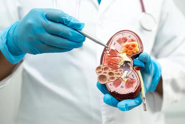 Enfrentan riesgo de desarrollar enfermedad renal crónica 40 % de diabéticos