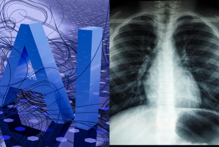 La detección oportuna con IA reduce la mortalidad por cáncer de pulmón, según un estudio