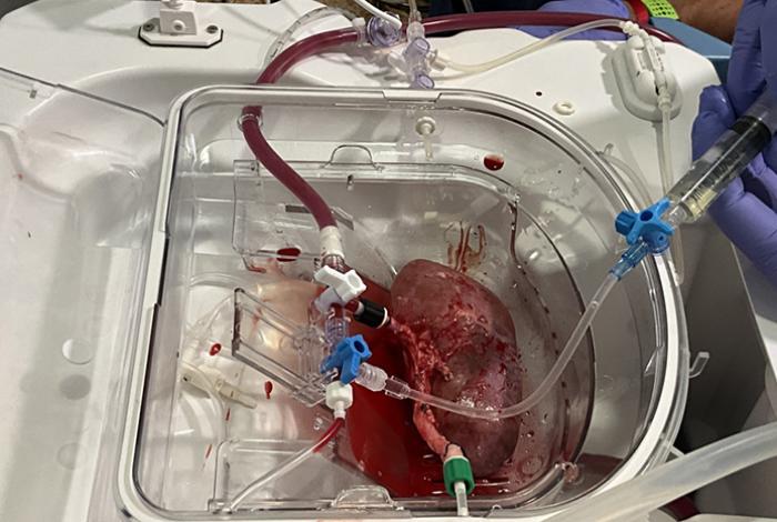 Logran primer trasplante a cerdos de riñones porcinos modificados con organoides humanos