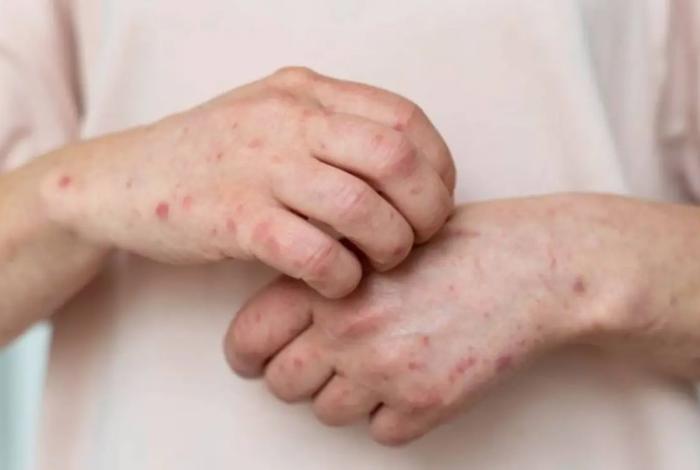 Michoacán, entre los cuatro estados con más casos de sarampión; Ssa adelanta ‘dosis cero’