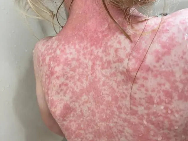 Michoacán sumó 3 casos de sarampión en las últimas 24 horas; suman 153 en total