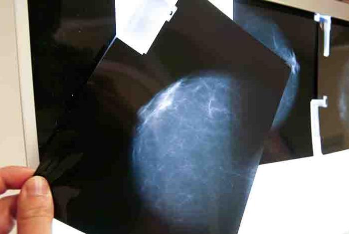 Relacionan la alta densidad mamaria con los tumores más agresivos y de peor pronóstico