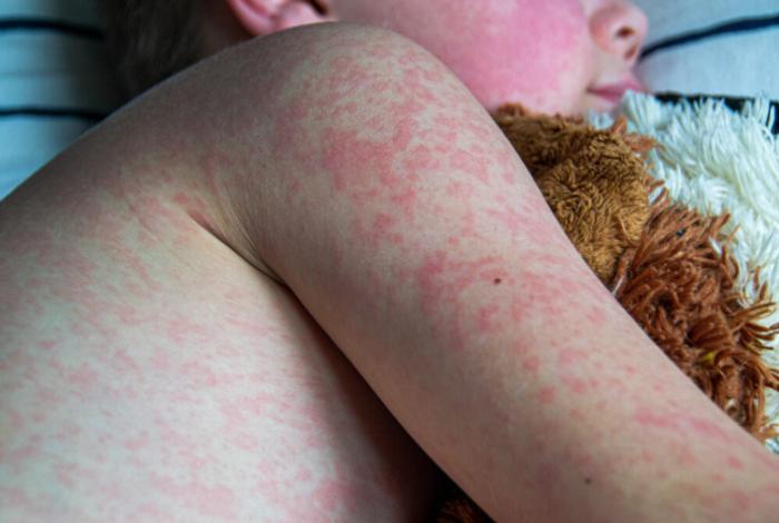  Reportan la primer muerte por sarampión en Guerrero