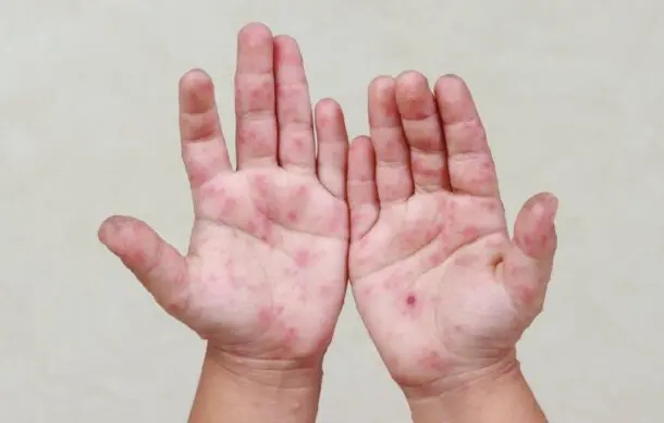 Se convierte Jalisco en el estado con mas contagios de Sarampión