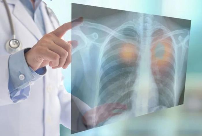 Se diagnostican tarde 80% de cánceres de pulmón; urgen a mejorar políticas públicas