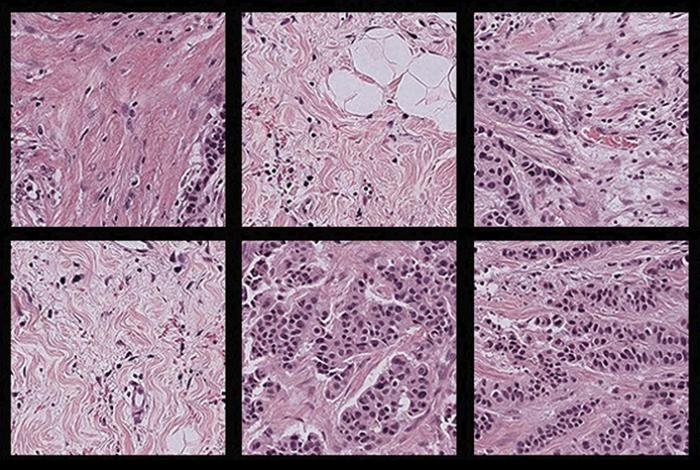 Una nueva herramienta reduce el sesgo de los análisis patológicos con IA